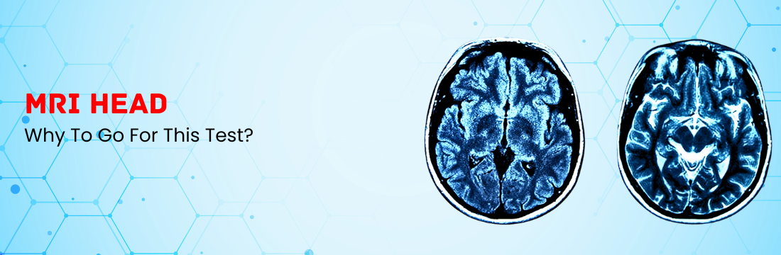 MRI Head: Why To Go For This Test?